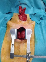 sternotomie partielle pour ablation du thymus